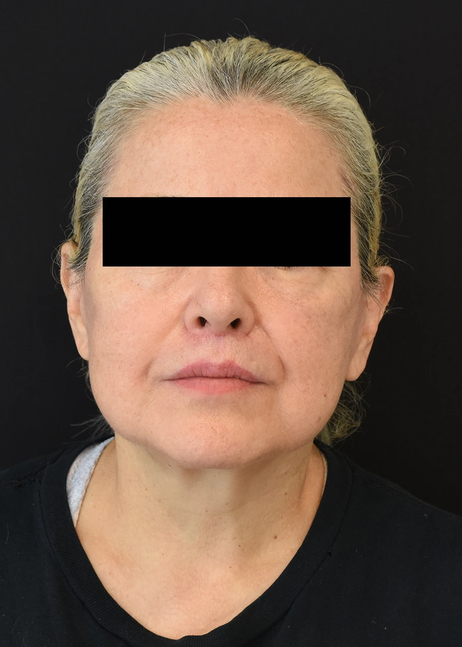 Neck Lift Patient 23 Set 1 After